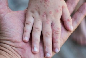 Estos son los síntomas de la polio, rubeola y sarampión