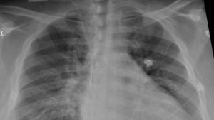 Neumólogos españoles revelan que el déficit de alfa-1 antitripsina aumenta la gravedad y la mortalidad en pacientes con Covid-19