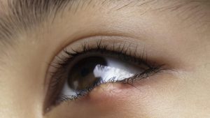 Qué son los orzuelos y por qué salen: los malos hábitos que se deben evitar