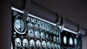 Nuevo descubrimiento sobre las causas de la demencia: encuentran regiones específicas del cerebro dañadas por la hipertensión