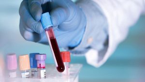 El VIH, la hepatitis B y la hepatitis C pueden detectarse a partir de una sola gota de sangre, según un estudio