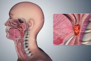 El sexo oral es un factor principal para el cáncer de garganta