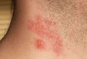¿Se ha reactivado el virus del herpes zóster? Aumenta 15% la demanda de antivirales