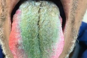La lengua de un hombre se volvió verde y ‘peluda’