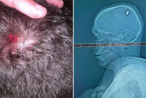 Mateus Facio, de 21 años, pasó cuatro días con una bala dentro de su cabeza