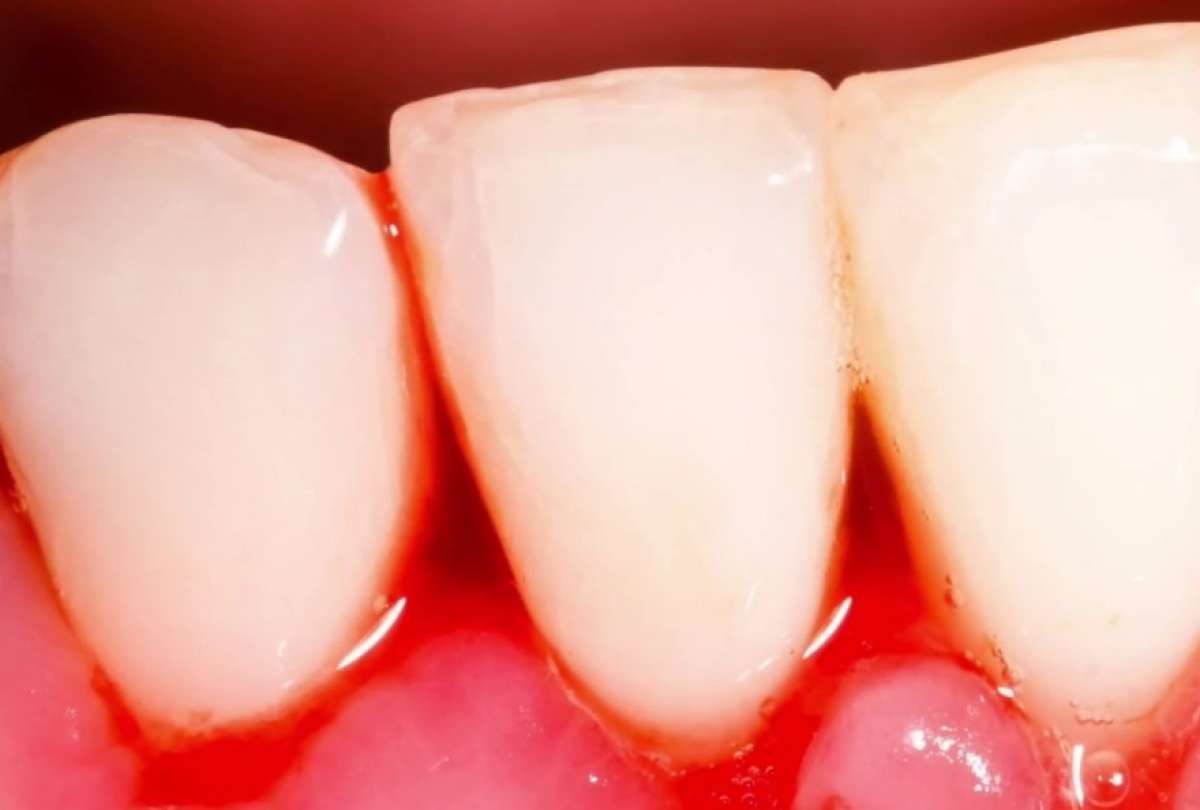 El sangrado de las encías durante los procedimientos rutinarios de higiene bucal