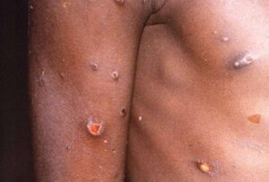 La Organización Mundial de la Salud (OMS), descartó que el mpox, mejor conocida como Viruela del Mono se la pueda considerar “un nuevo Covid”