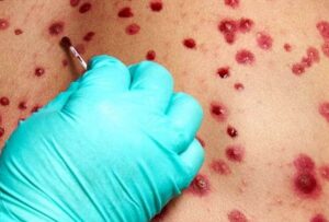 Un buque que se trasladaba desde Liberia hacia Brasil, permanece aislado al detectarse un caso sospechoso de viruela símica