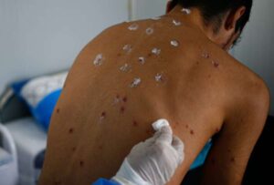 El Ministerio de Salud Pública del Ecuador (MSP) se mantiene en alerta sanitaria por el incremento de casos de MPOX (viruela símica) a nivel mundial