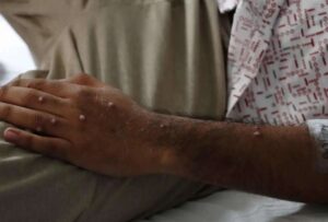La Organización Mundial de la Salud (OMS) declara nuevamente a la viruela del mono, como una emergencia de salud pública de interés internacional