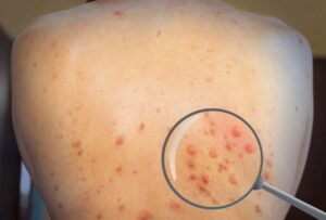 En Argentina, los casos de viruela símica aumentan