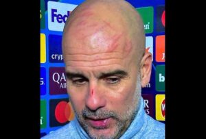 Pep Guardiola apareció con rasguños en la nariz y la cabeza