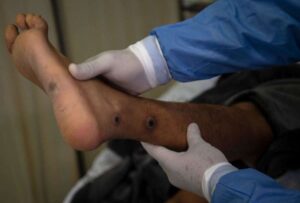 Confirman cinco casos de viruela del mono en China