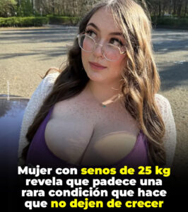 Mujer británica de 25 años, con senos talla O que pesan 25 kg, reveló que padece gigantomastia