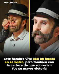 Conocido como “el hombre con un hueco en el rostro”