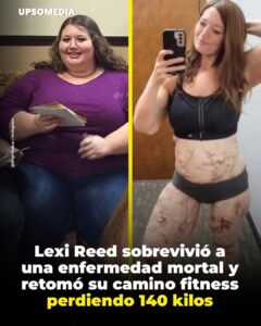 Su avance se detuvo tras ser diagnosticada con calcifilaxis