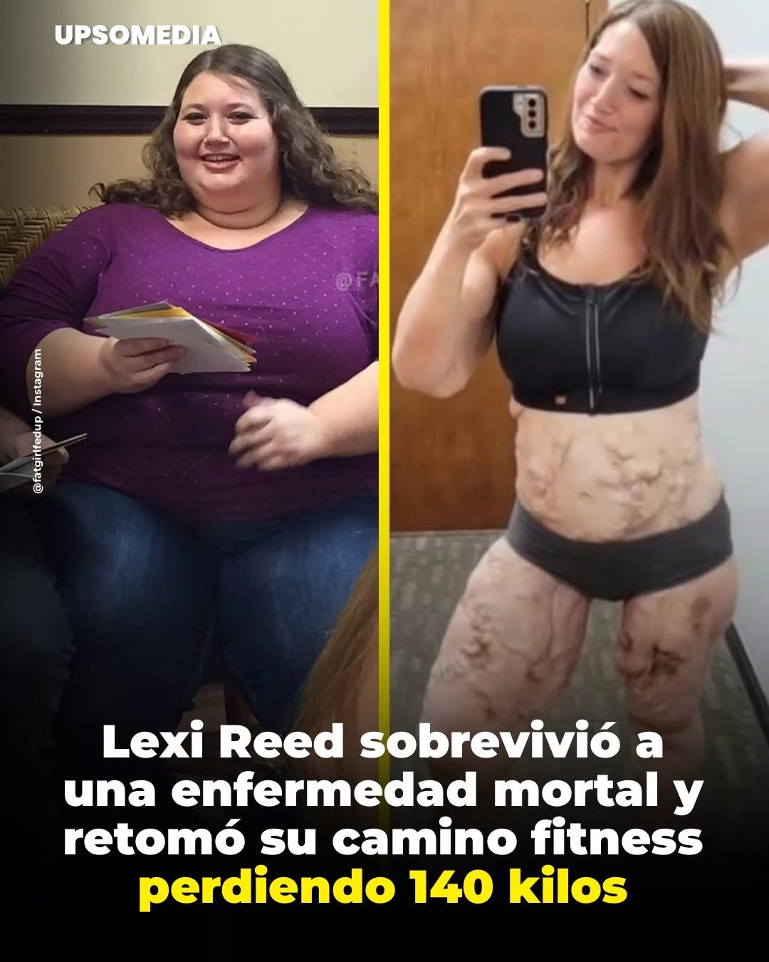 Su avance se detuvo tras ser diagnosticada con calcifilaxis