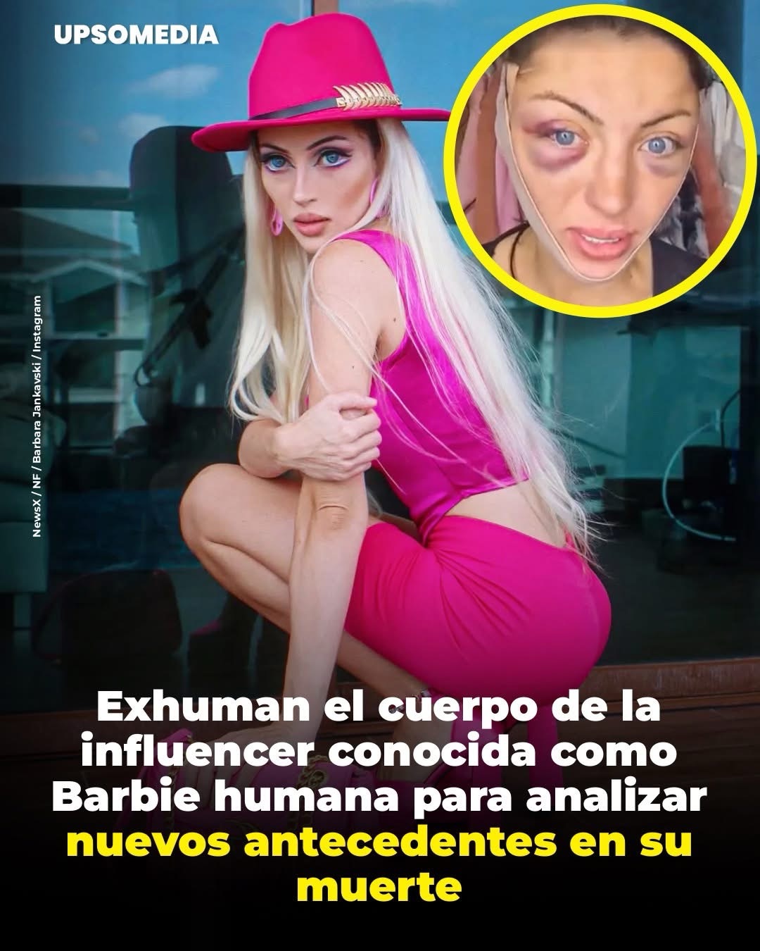 Barbie humana, fue exhumado dos meses después de su muerte como parte de una nueva etapa de la investigación