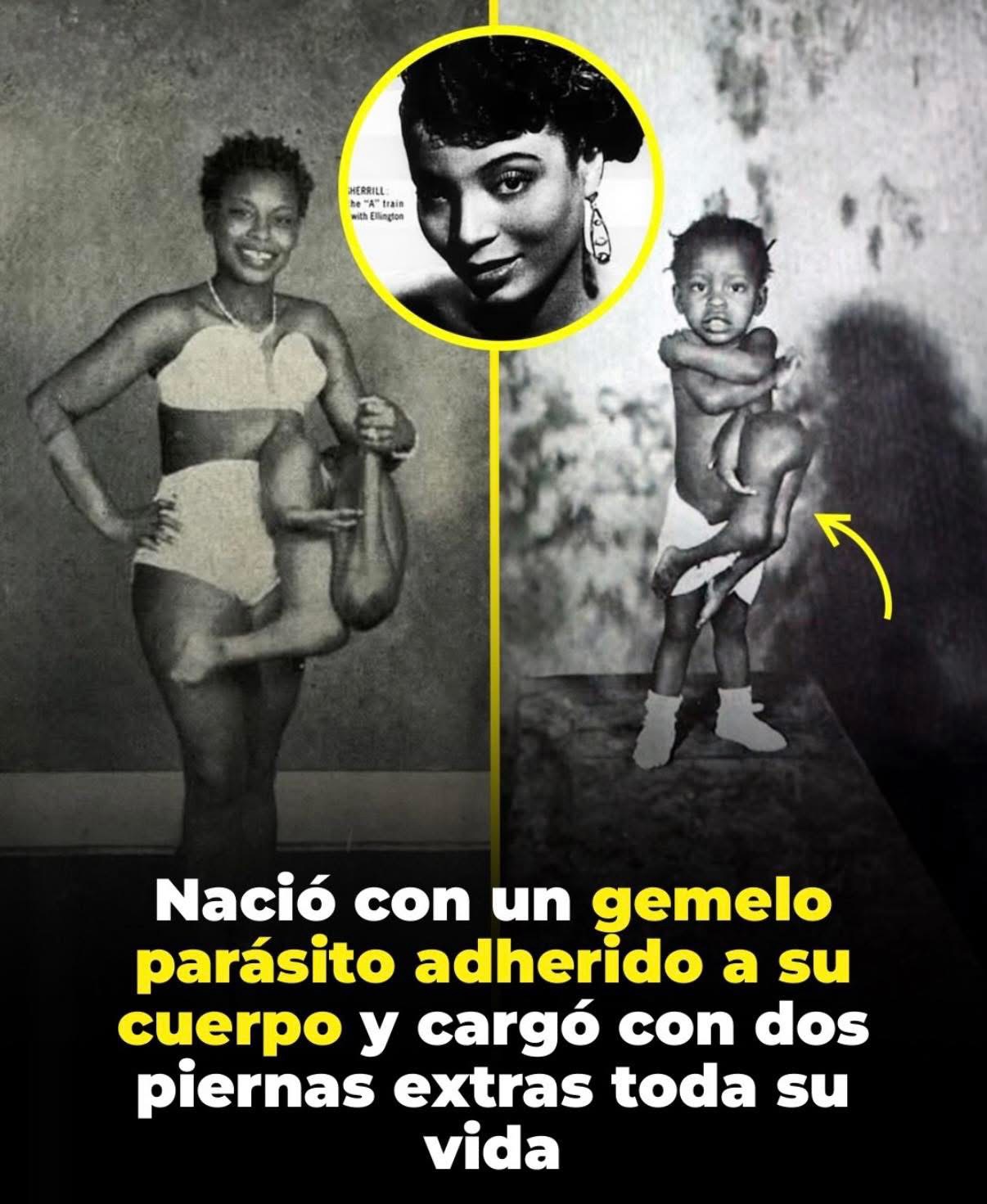 Betty Lou Williams nació en Georgia, EE. UU en 1932 con una condición rarísima: un gemelo parásito unido a su cuerpo
