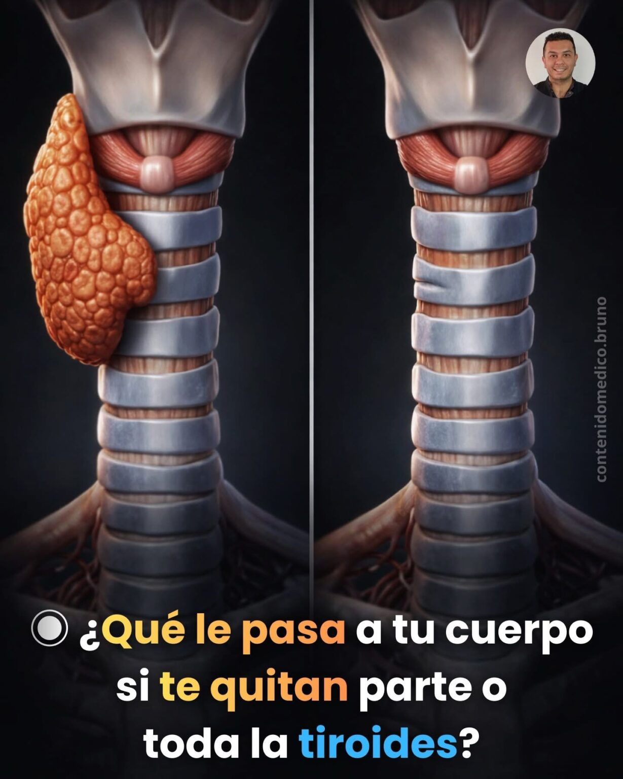 ¿Qué le pasa a tu cuerpo si te quitan parte o toda la tiroides?