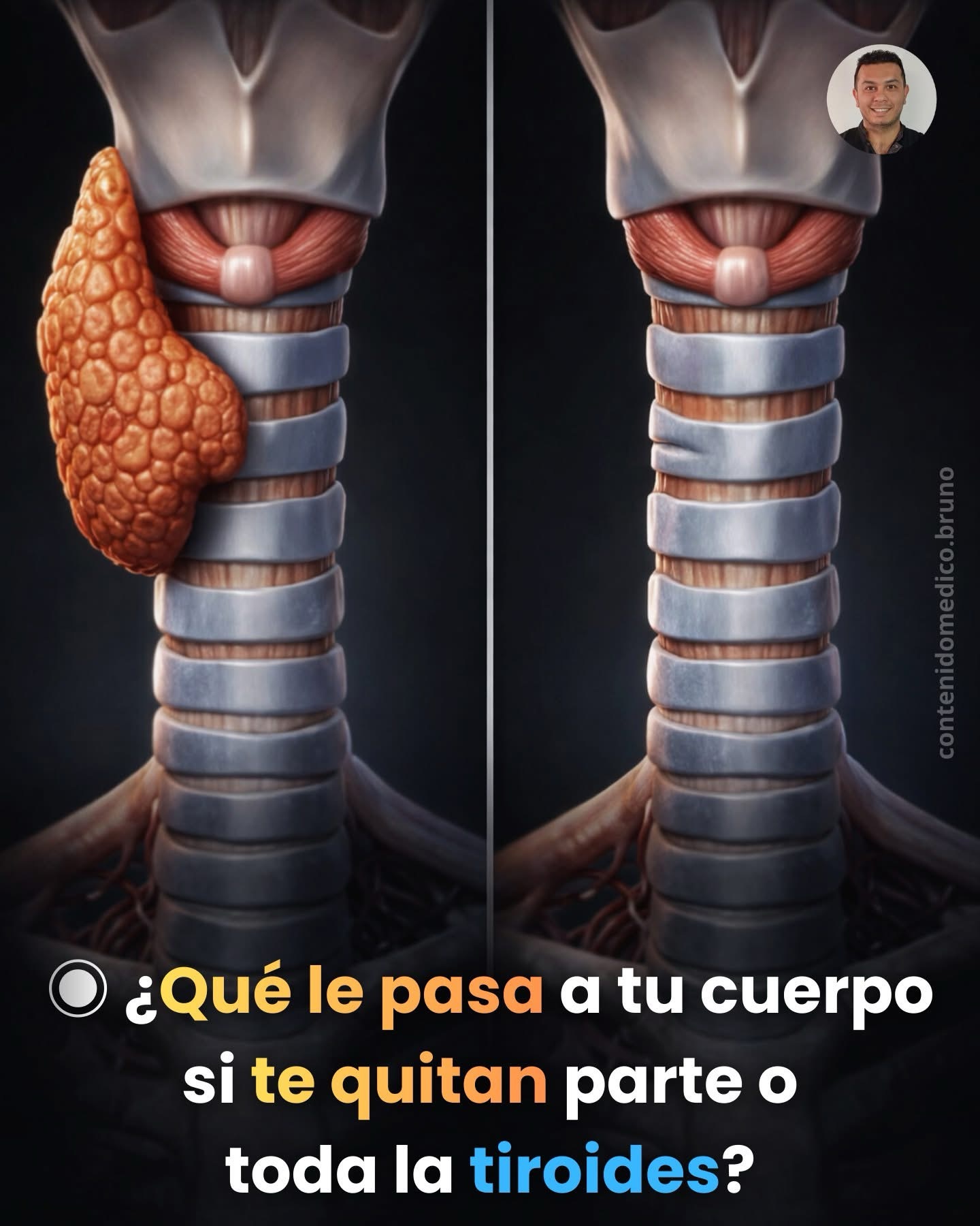 ¿Qué le pasa a tu cuerpo si te quitan parte o toda la tiroides?