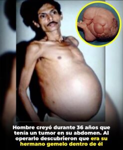 Sanju Bhagat, nacido en 1963 en Nagpur, India, creció con un vientre anormal