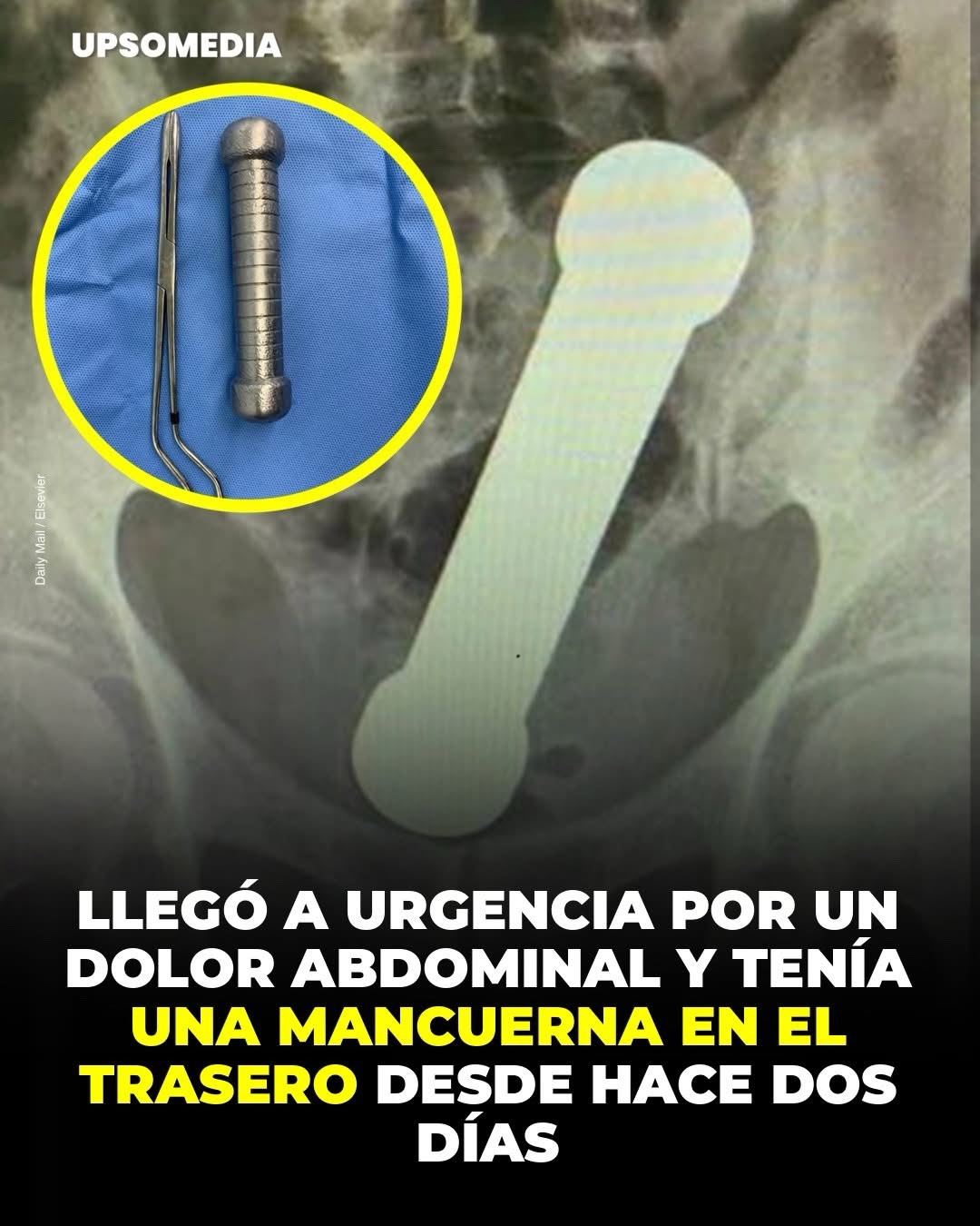 Un hombre brasileño de 54 años llegó a emergencias con un intenso dolor abdominal, pero la sorpresa de los médicos fue enorme al revisar las radiografías: el paciente tenía una mancuerna de 2 kilos en el interior de su trasero