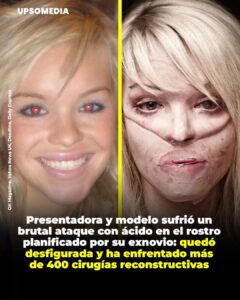 Presentadora Katie Piper fue atacada con ácido en plena calle