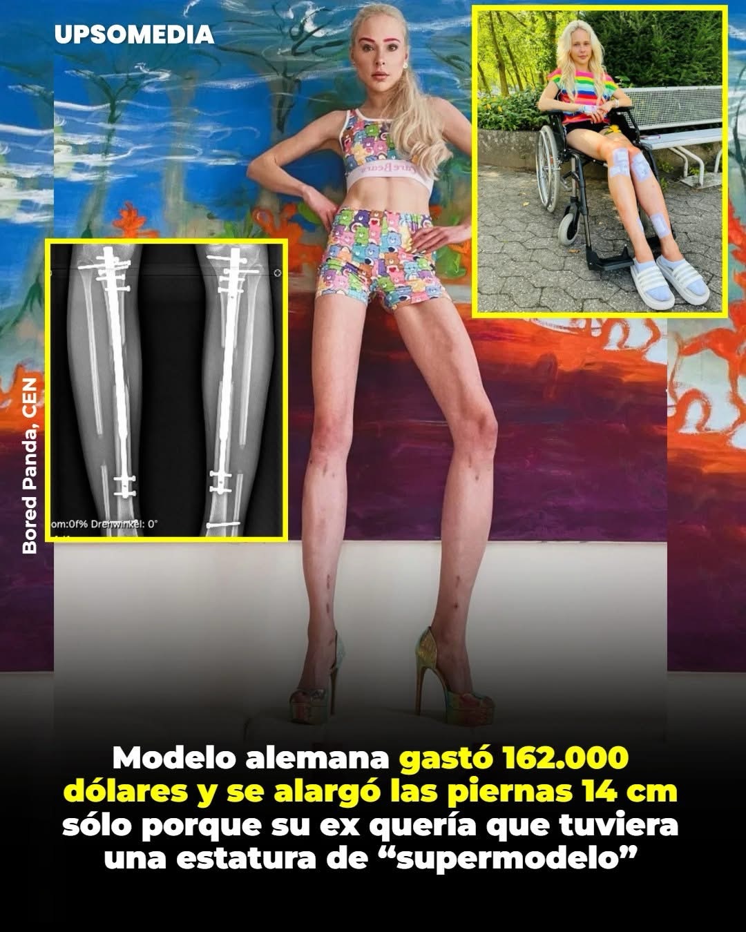 Theresia Fischer decidió someterse a una compleja cirugía para alargar sus piernas