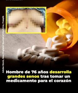 Un hombre de 76 años fue diagnosticado con ginecomastia