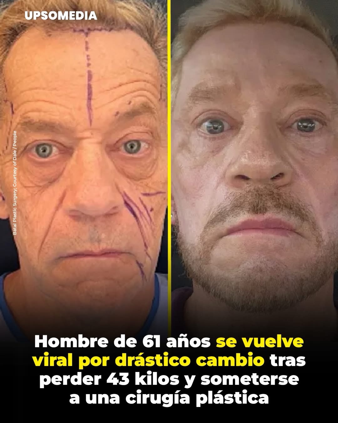 Dale Thompson, de 61 años, se sometio a una cirugía plástica transformadora
